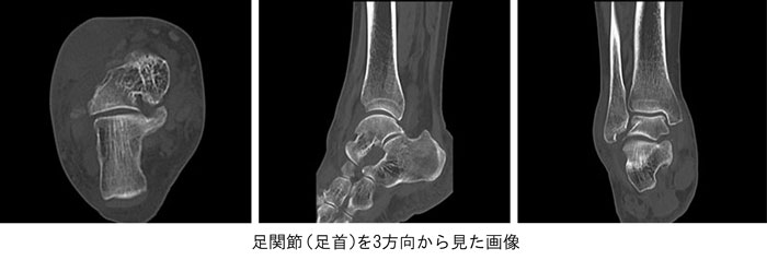 骨・四肢CTの画像