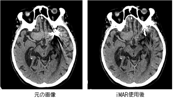 CTの画像