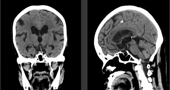 頭部CTの画像