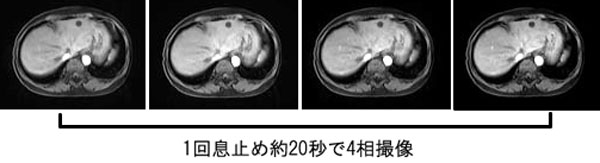 MRI撮影画像